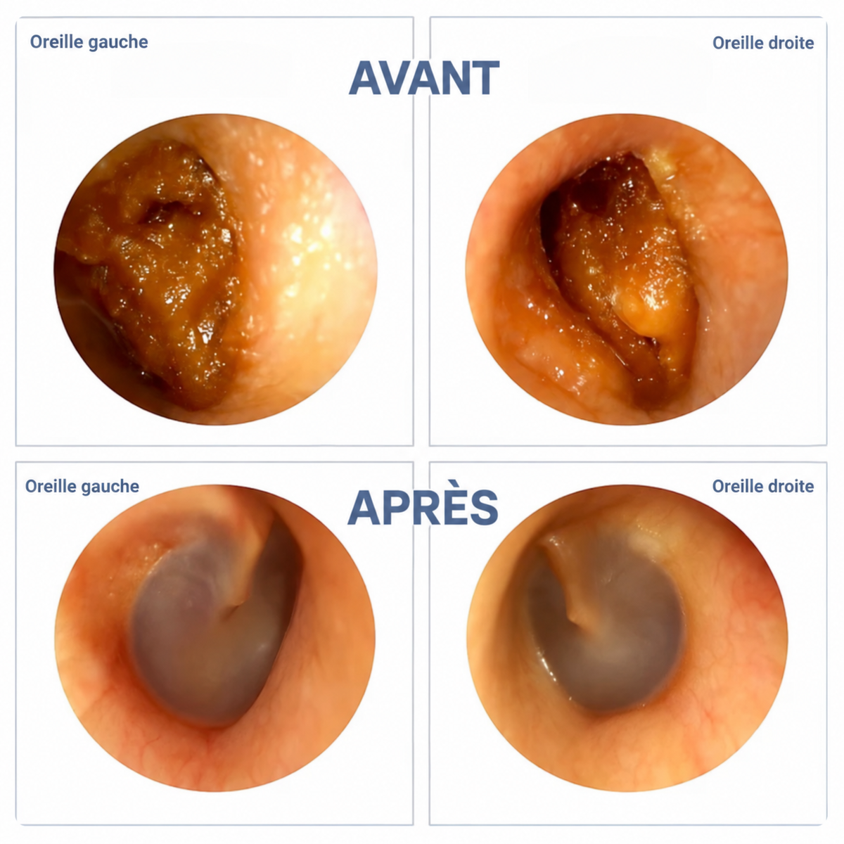 Novixa™ — Nettoyeur d’Oreilles Intelligent avec Caméra HD
