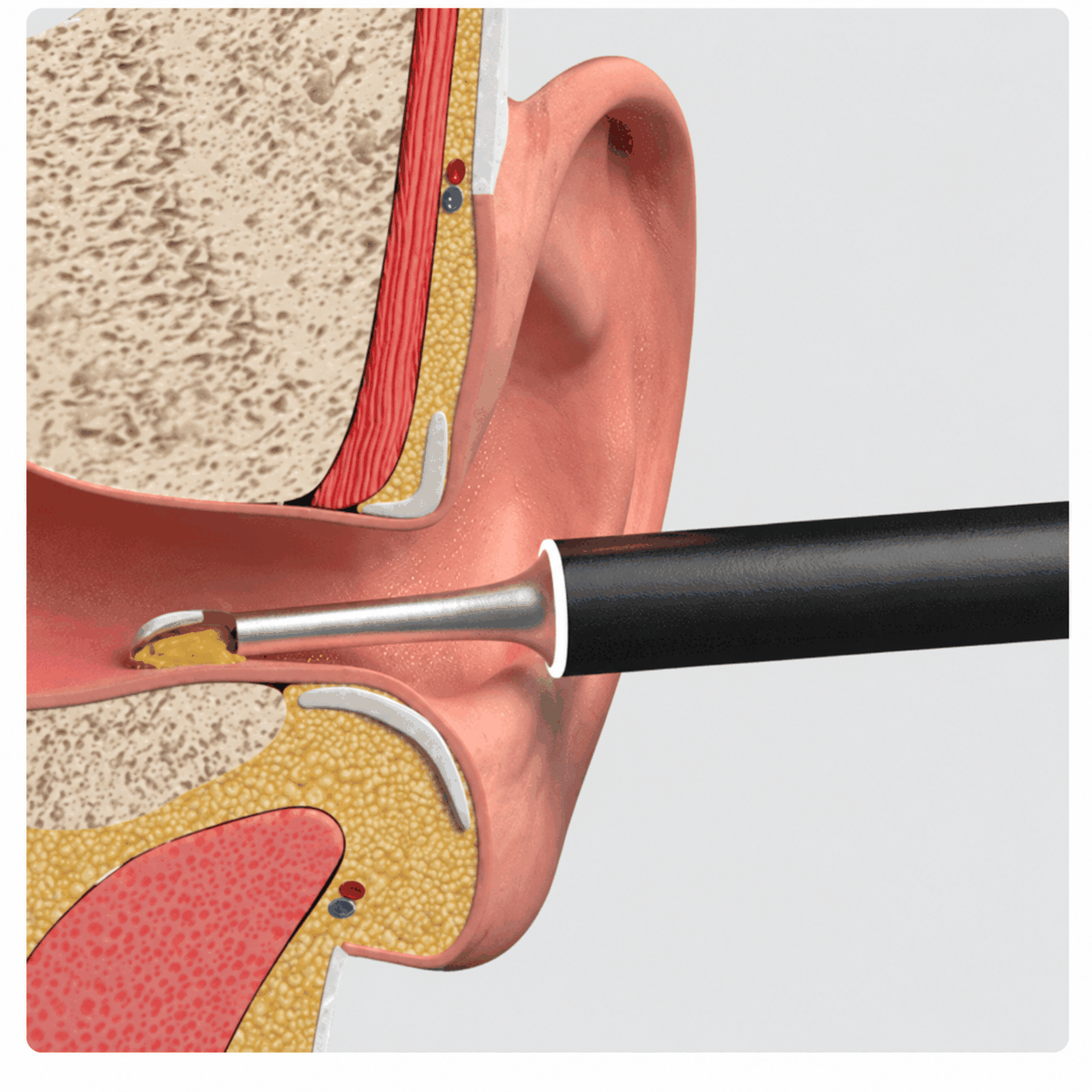 Novixa™ — Nettoyeur d’Oreilles Intelligent avec Caméra HD